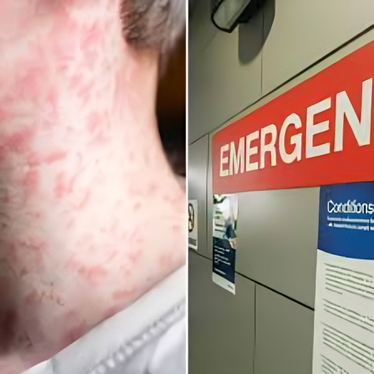 6+* Measles Exposure Alerts Issued in SA and NSW After Airport Contact