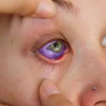 Tattoo Linked to Rare Eye Condition After Chef Nearly Loses Her Vision